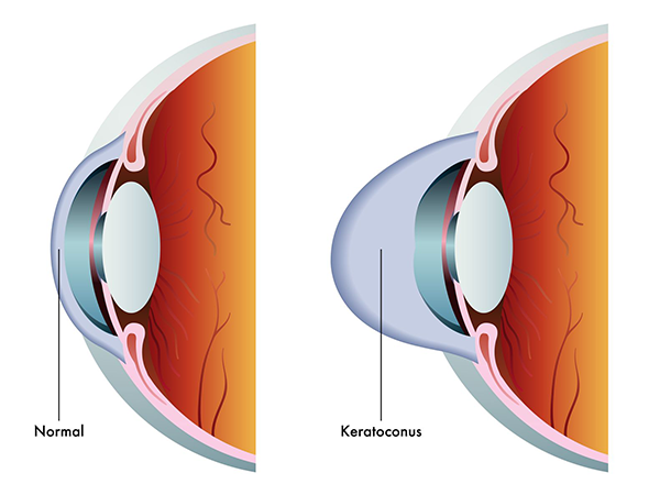 Keratoconus Treatment in Tucson