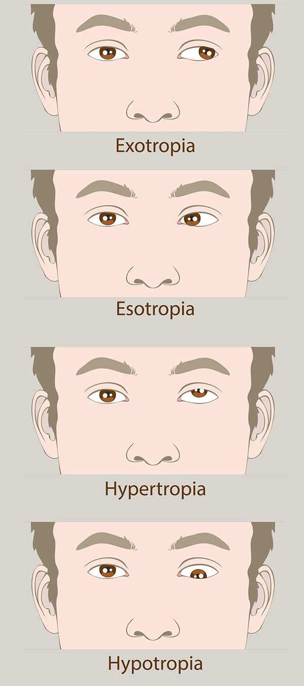 Lazy Eye Treatment in Tucson