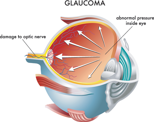 Glaucoma Treatment in Tucson