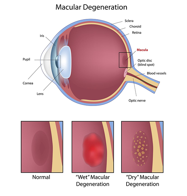 Macular Degeneration Tucson