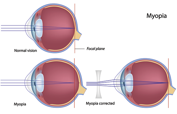 myopia és hyperopia kezelése