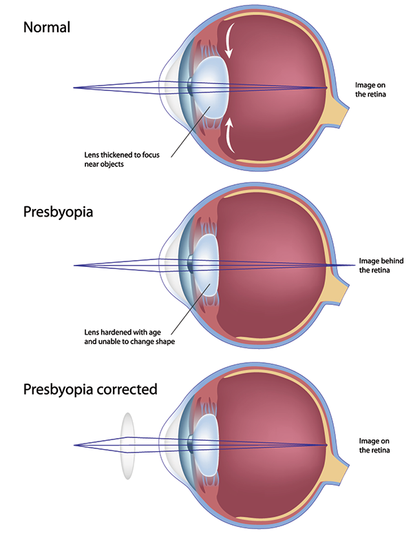 Presbyopia in Tucson