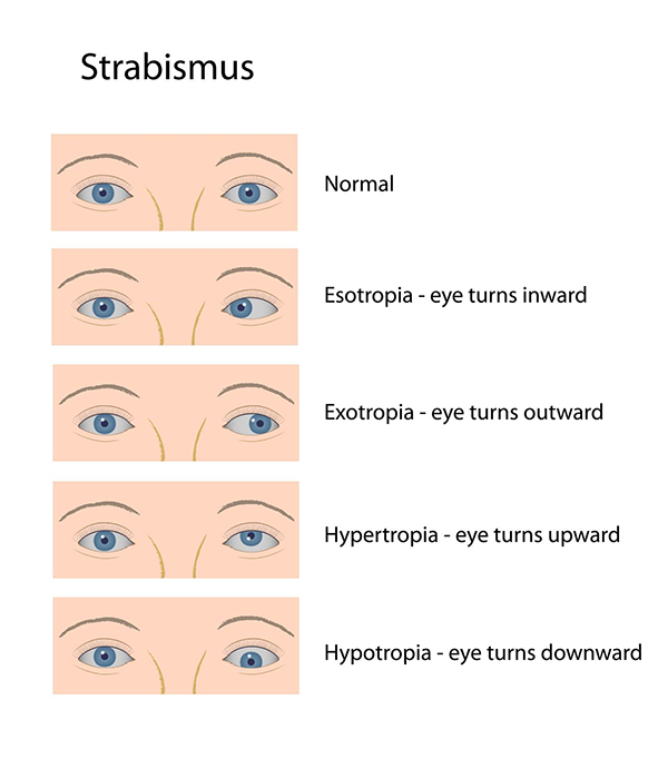 Tucson Strabismus Treatment